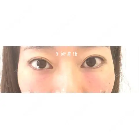 クマ治療 / 下まぶたたるみ取り / 下まぶたの脂肪取り セオリークリニック DAY 0