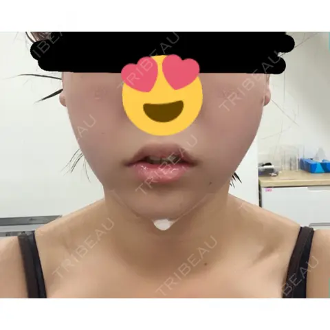糸リフト / 脂肪吸引（顔） / 下まぶたの脂肪取り / ジョールファット除去 / ボトックス（エラ・小顔） / その他（目元） SEA CLINIC（シークリニック） DAY 0