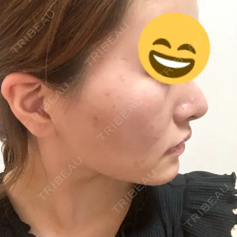 ハイフ（顔） TCB東京中央美容外科 福岡博多院 DAY 1