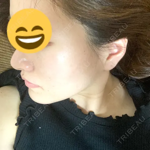 ハイフ（顔） TCB東京中央美容外科 福岡博多院 AFTER
