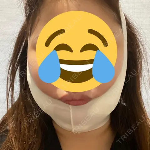 バッカルファット除去 / 脂肪吸引（顔） / 脂肪吸引（二の腕） 湘南美容クリニック 千葉センシティ院 DAY 0