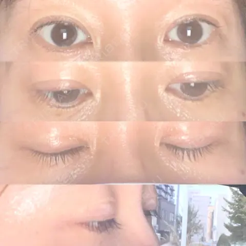 二重切開 蘇春堂形成外科 AFTER