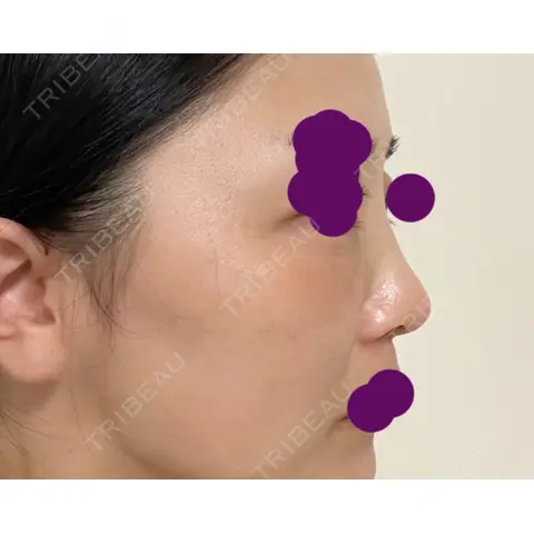軟骨移植 フェアクリニック川口 AFTER