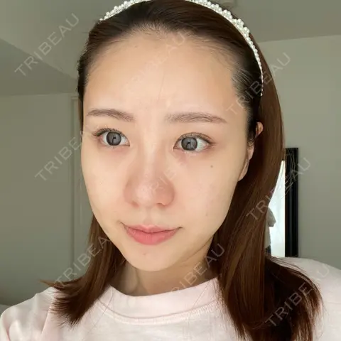 水光注射（ハリ・美肌） 表参道ウィズ・クリニック AFTER