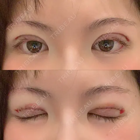 二重切開 水の森美容クリニック 東京銀座院 DAY 0