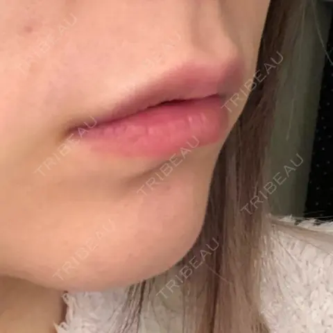 ヒアルロン酸注入（唇） 青山外苑前クリニック AFTER