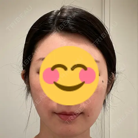 アートメイク（唇） LEAGRANT CLINIC 中目黒 AFTER