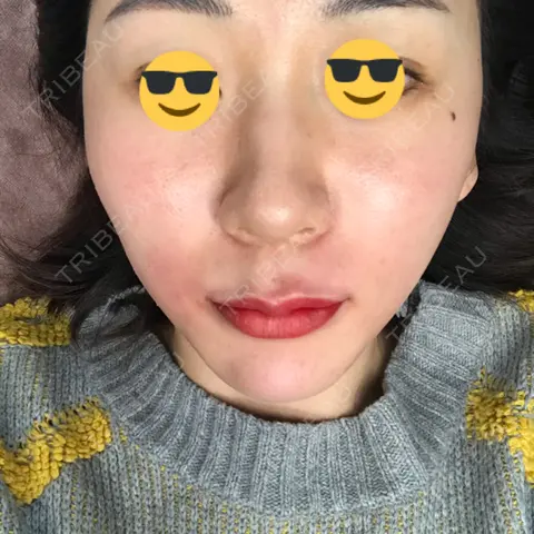 アートメイク（唇） LEAGRANT CLINIC 中目黒 DAY 0