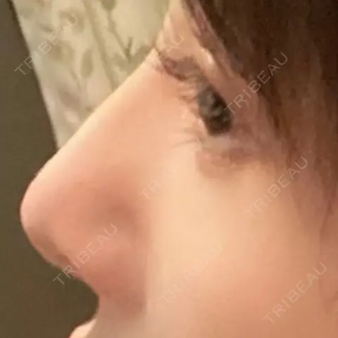 鼻尖形成（切開） / 軟骨移植 / 骨切幅寄せ THE ROPPONGI CLINIC（ザ 六本木クリニック） AFTER