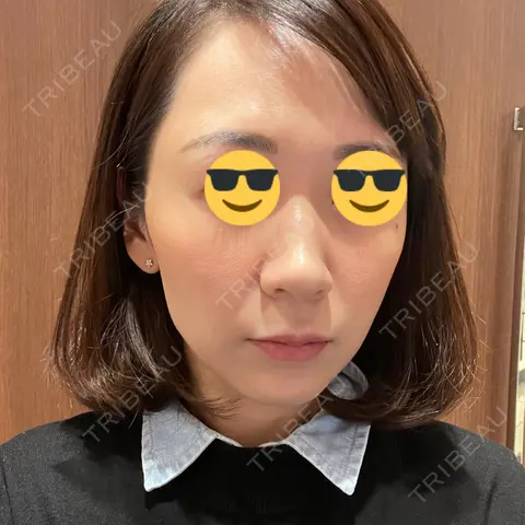 アートメイク（唇） LEAGRANT CLINIC 中目黒 AFTER