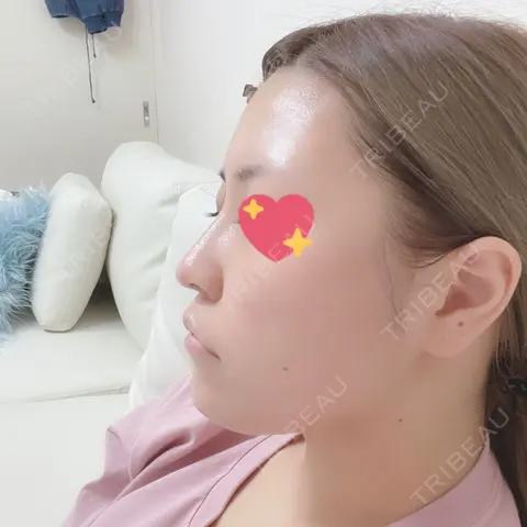 ヒアルロン酸注入（鼻） / ボトックス（あご） / ヒアルロン酸注入（あご） アクトリー勝どきウェルネスメディカルクリニック DAY 0