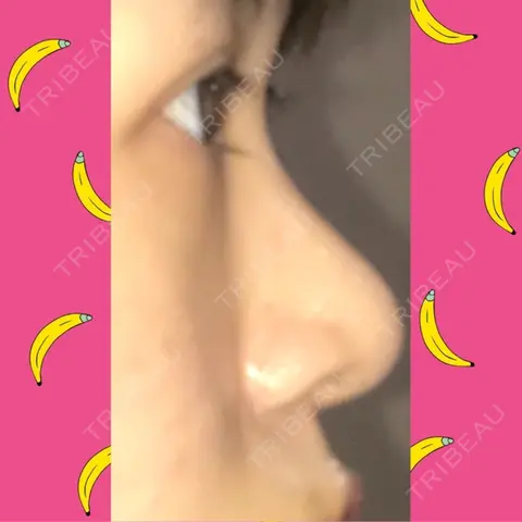 鼻尖形成（切開） / 小鼻縮小（切開） / 軟骨移植 / 鼻孔縁挙上 / 鼻尖縮小 ヴェリテクリニック 大阪院 AFTER