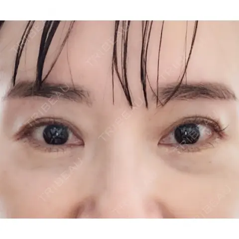 二重切開 / 眼瞼下垂（切開） 芦屋美容クリニック 芦屋院 AFTER