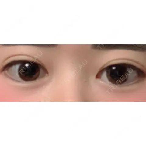二重切開 品川美容外科 千葉院 AFTER