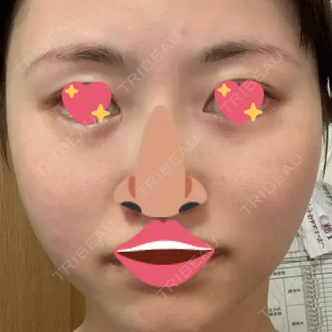 ルビーレーザー 南青山TOKUNAKAクリニック AFTER