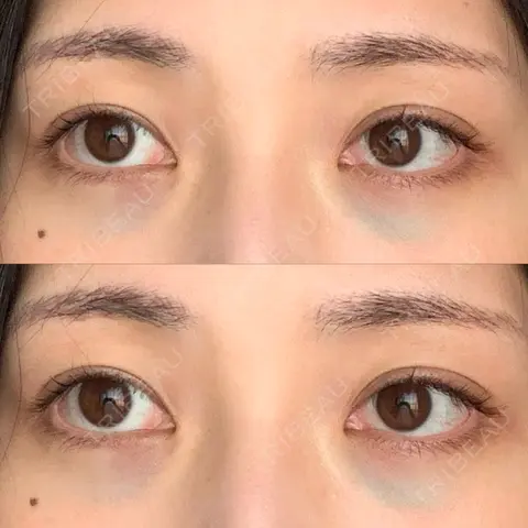 下まぶたの脂肪取り APOLLO BEAUTY CLINIC DAY 0