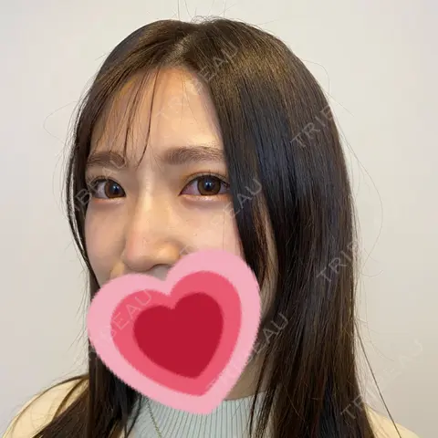 ヒアルロン酸注入（鼻） / ヒアルロン酸注入（あご） アクトリー勝どきウェルネスメディカルクリニック AFTER