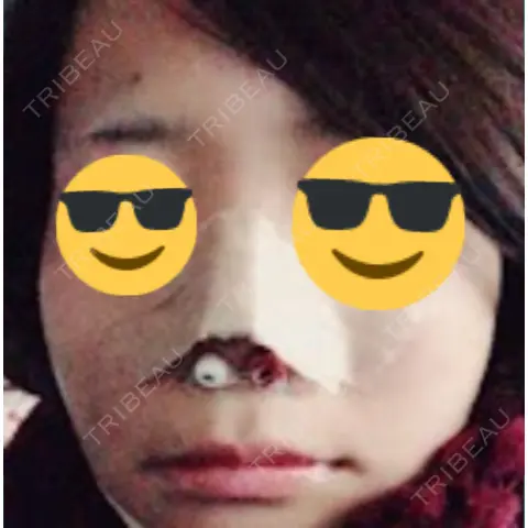 鼻尖形成（切開） / 小鼻縮小（切開） あつぎ美容クリニック DAY 0