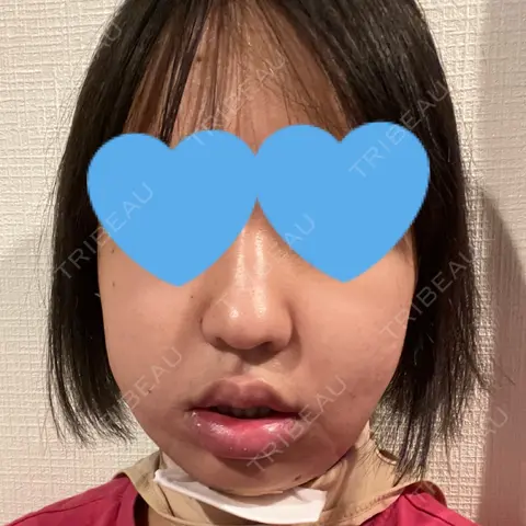 糸リフト / 脂肪吸引（顔） 藤・ナチュレ美容クリニック 恵比寿院 DAY 0