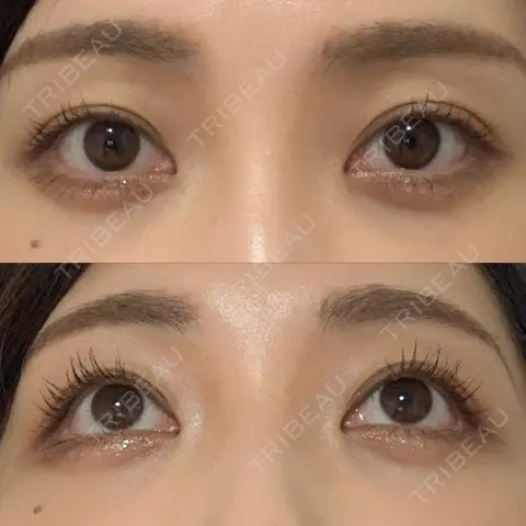 下まぶたの脂肪取り APOLLO BEAUTY CLINIC AFTER