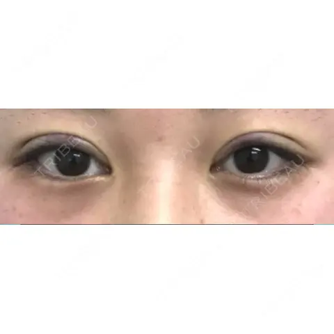 二重切開 / 上まぶたの脂肪取り アモーレクリニック 名古屋院 DAY 0