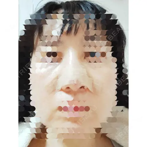 鼻尖形成（切開） / 鼻尖縮小 / ヒアルロン酸注入（鼻） 東京形成美容外科 船橋院 DAY 0