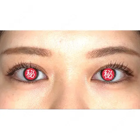 二重埋没 品川美容外科 千葉院 AFTER