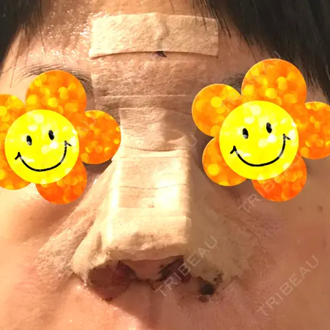 鼻尖形成（切開） / 鼻中隔延長（切開） / 軟骨移植 / 鼻尖縮小 / その他（鼻） ジョウクリニック 那覇院 DAY 1
