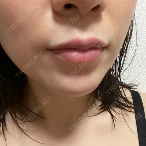 アートメイク（唇） LEAGRANT CLINIC 中目黒 AFTER