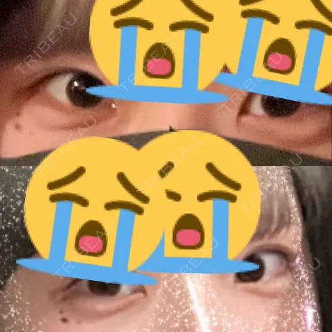 ヒアルロン酸注入（涙袋） ロレシー美容クリニック 心斎橋駅前院 AFTER