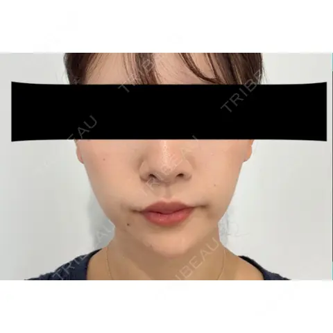 糸リフト / 脂肪吸引（顔） / 下まぶたの脂肪取り / ジョールファット除去 / ボトックス（エラ・小顔） / その他（目元） SEA CLINIC（シークリニック） AFTER