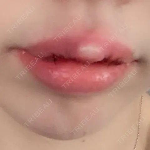 口唇縮小術 YBC横浜美容外科 大宮院 DAY 0
