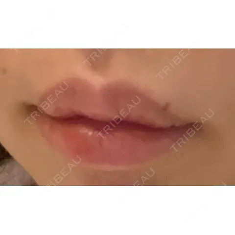 口唇縮小術 YBC横浜美容外科 大宮院 AFTER
