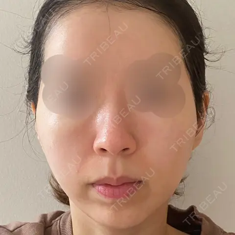 糸リフト 湘南美容クリニック 渋谷院 AFTER