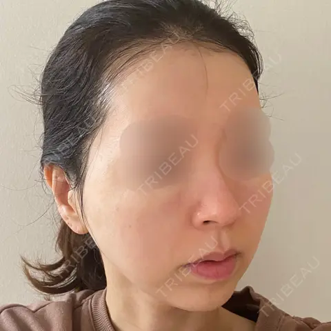 糸リフト 湘南美容クリニック 渋谷院 AFTER