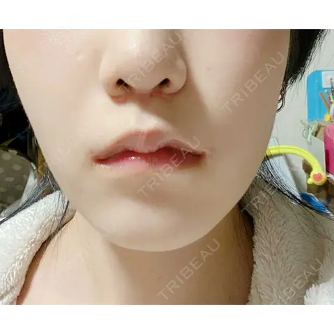 バッカルファット除去 / 脂肪吸引（顔） / ジョールファット除去 湘南美容クリニック 藤沢院 AFTER