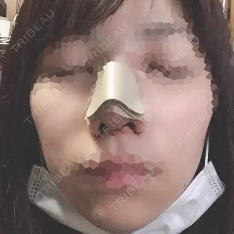 隆鼻術 / 鼻尖形成（切開） / 小鼻縮小（切開） 湘南美容クリニック 岡山院 DAY 0