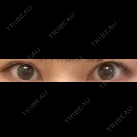二重埋没 お茶の水美容形成クリニック AFTER