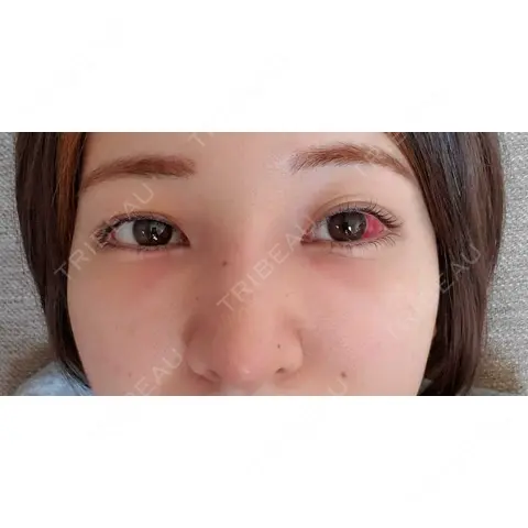 鼻尖形成（切開） / 鼻中隔延長（切開） / クマ治療 / 軟骨移植 R Beauty CLINIC 銀座院 AFTER