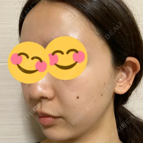 ピーリング（ニキビ・毛穴） 渋谷美容外科クリニック 池袋院 AFTER