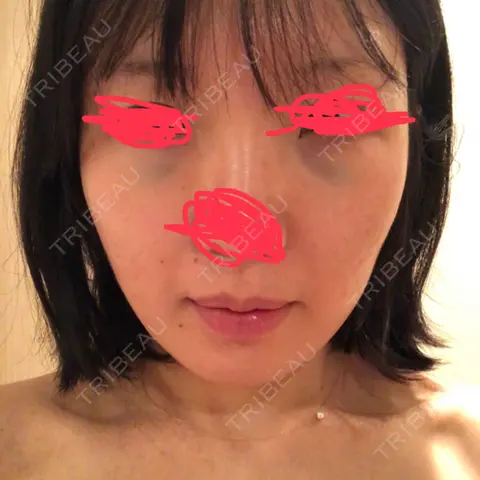 クマ治療 銀座マイアミ美容外科SALONE DAY 0