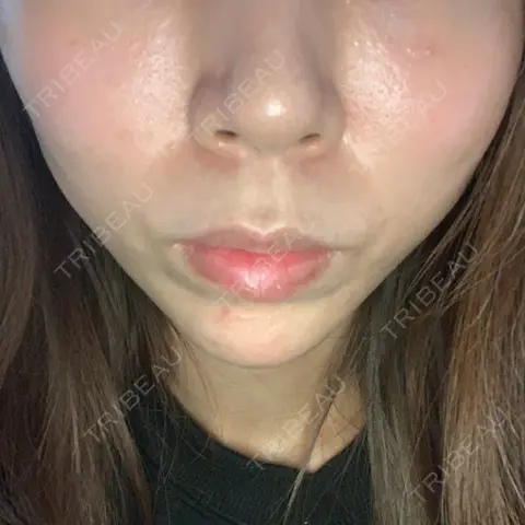 糸リフト ノーチェビューティクリニック DAY 1