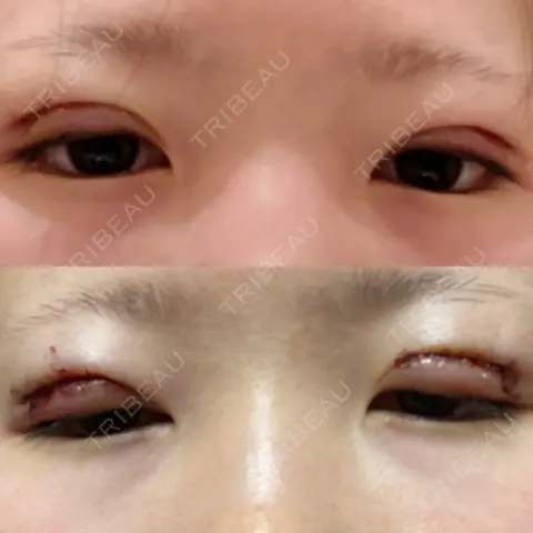 二重切開 水の森美容クリニック 東京銀座院 DAY 0