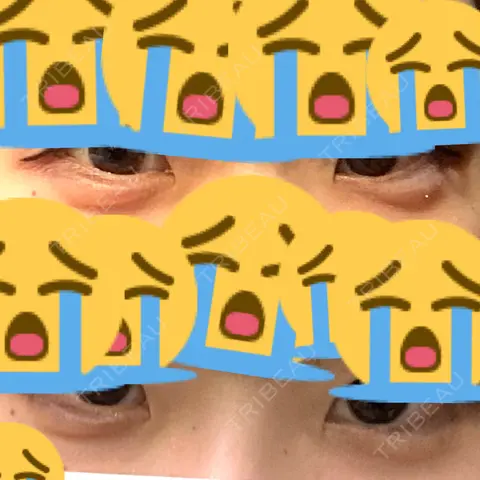 ヒアルロン酸注入（涙袋） ロレシー美容クリニック 心斎橋駅前院 AFTER