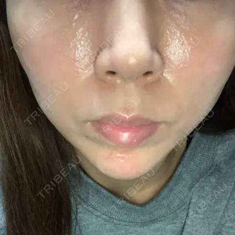 糸リフト ノーチェビューティクリニック AFTER
