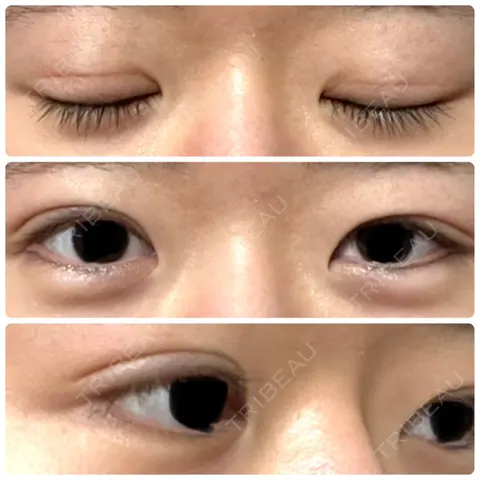 二重切開 / 眼瞼下垂（切開） 蘇春堂形成外科 AFTER