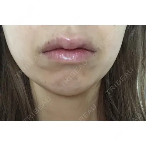 ボトックス（あご） / ボトックス（エラ・小顔） / ヒアルロン酸注入（唇） / ボトックス（口角） / ボトックス（人中） アリエル美容クリニック 大宮院 DAY 0