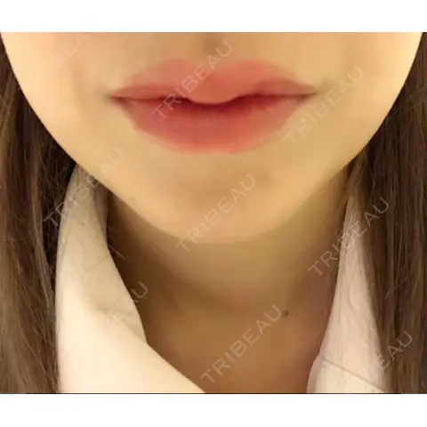 ボトックス（あご） / ボトックス（エラ・小顔） / ヒアルロン酸注入（唇） / ボトックス（口角） / ボトックス（人中） アリエル美容クリニック 大宮院 AFTER