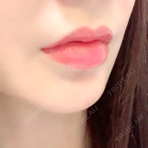 ヒアルロン酸注入（唇） / ボトックス（口角） ルラ美容クリニック 新宿院 AFTER