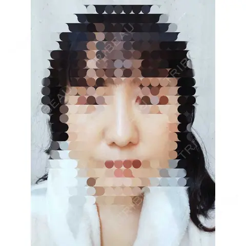 鼻尖形成（切開） / 鼻尖縮小 / ヒアルロン酸注入（鼻） 東京形成美容外科 船橋院 AFTER